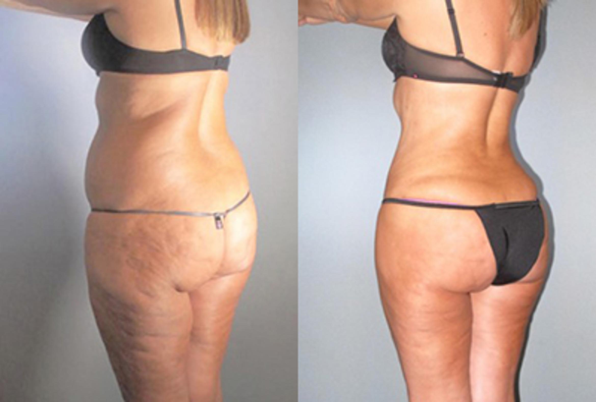 Before & After Brazilian Butt Lift Case 9144 View 1 View in Houston, TX