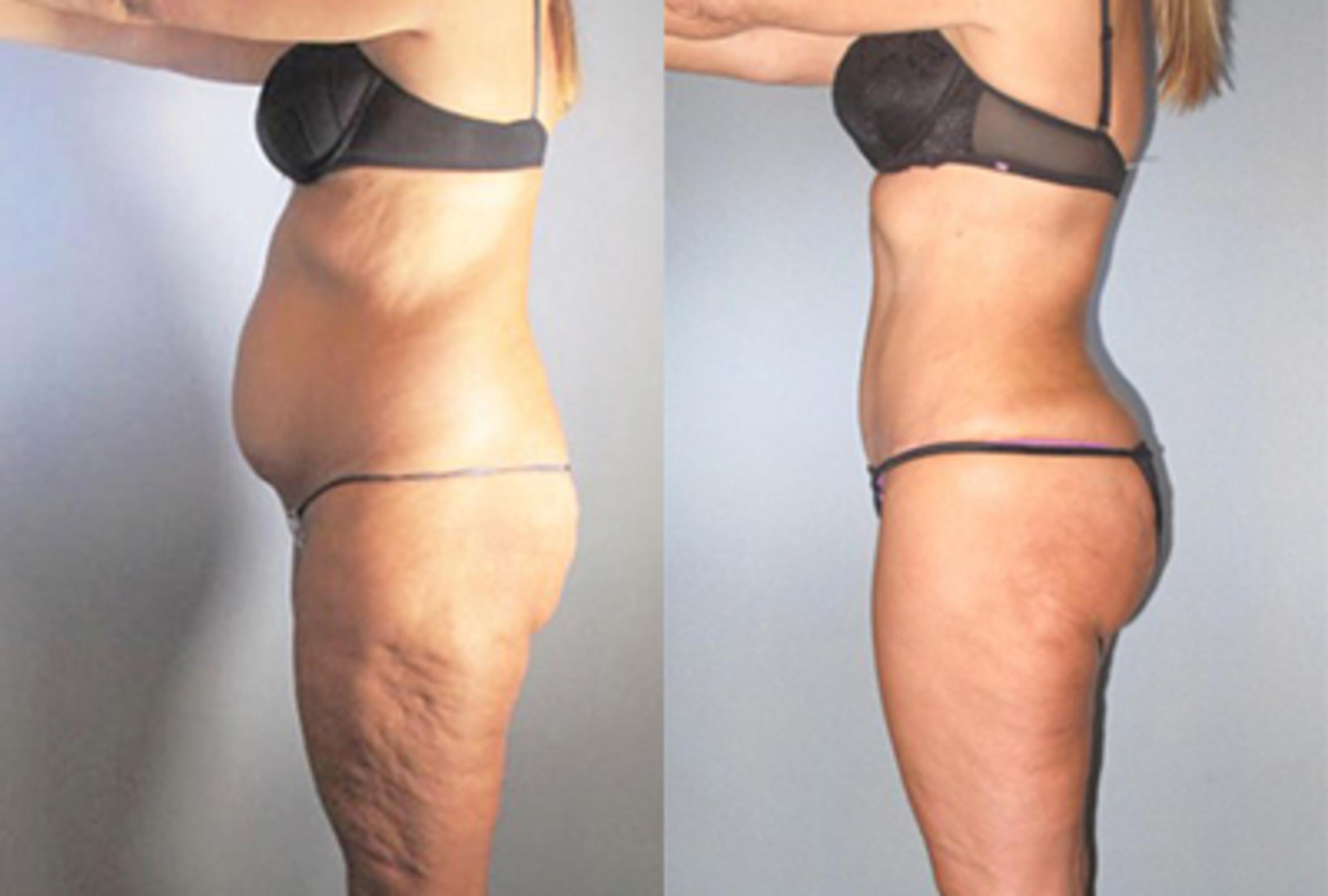 Before & After Brazilian Butt Lift Case 9144 View 2 View in Houston, TX