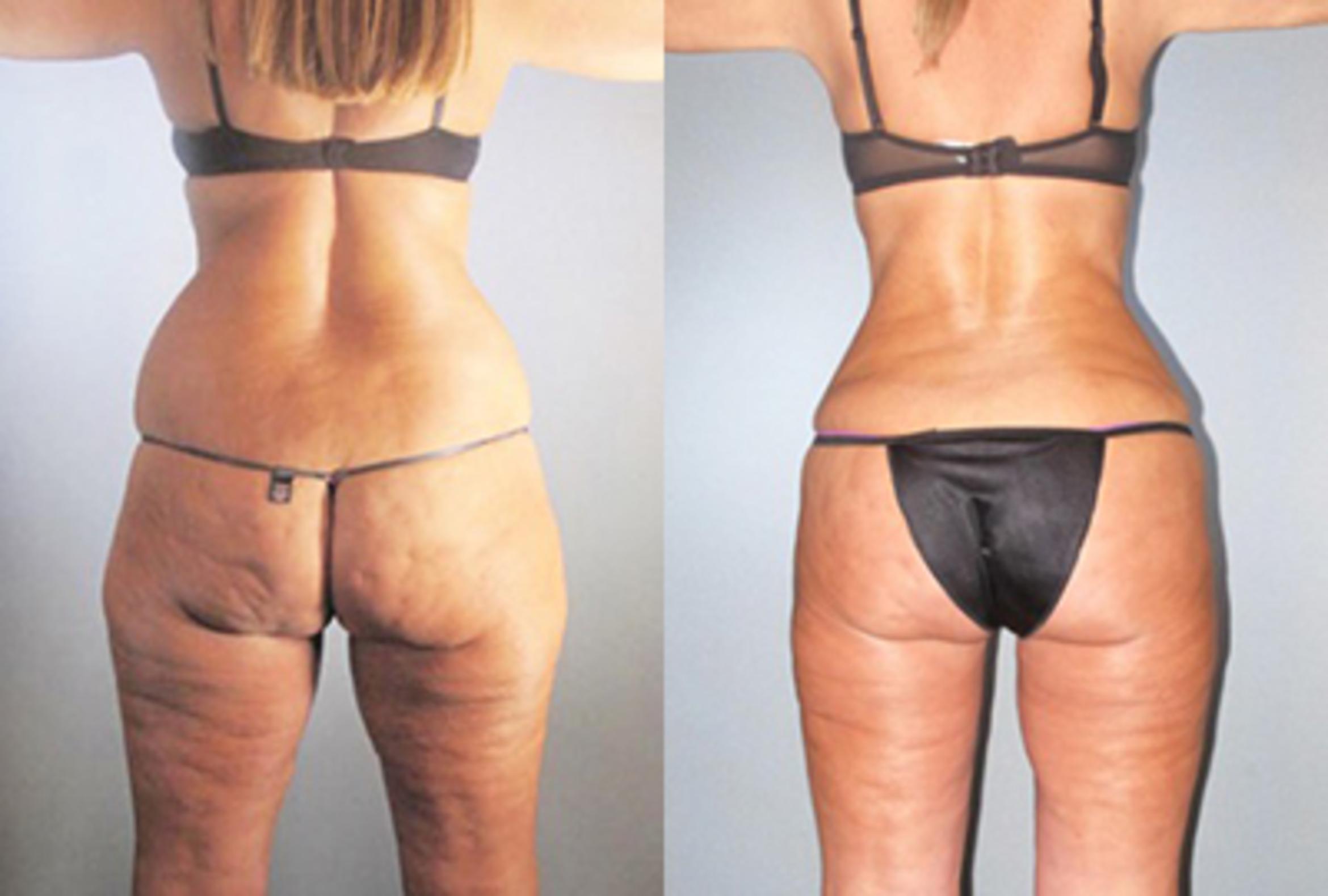 Before & After Brazilian Butt Lift Case 9144 View 3 View in Houston, TX