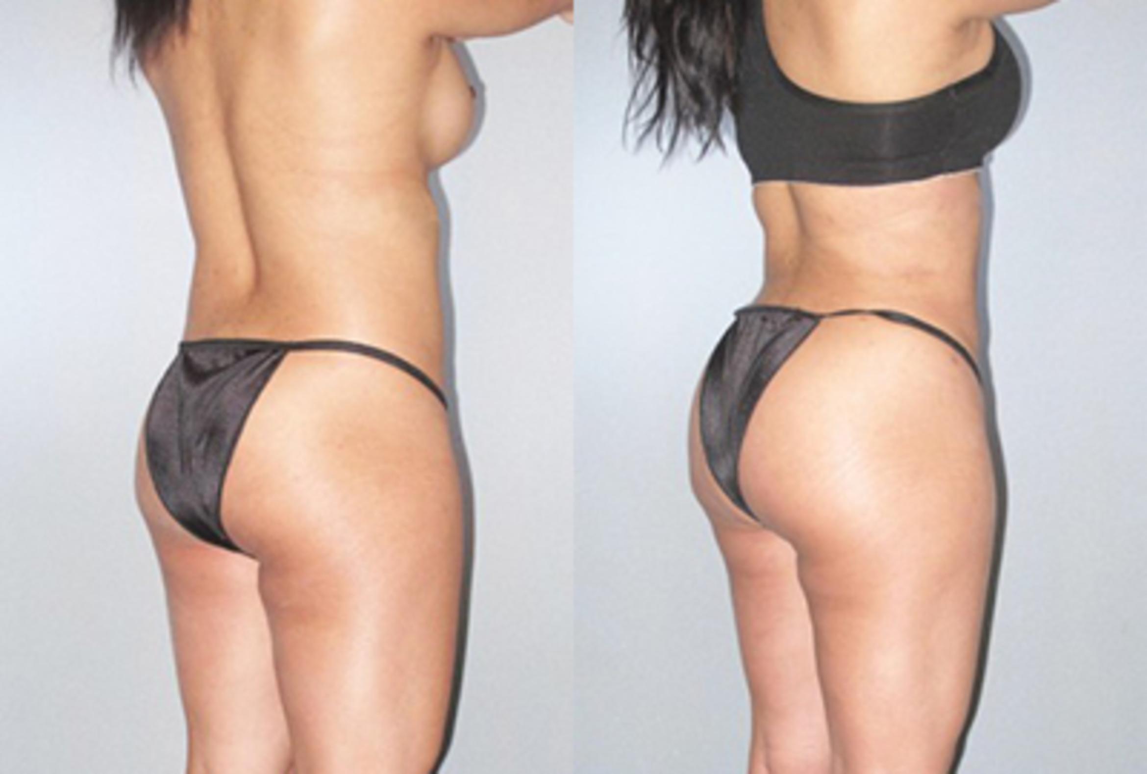 Before & After Brazilian Butt Lift Case 9235 View 1 View in Houston, TX