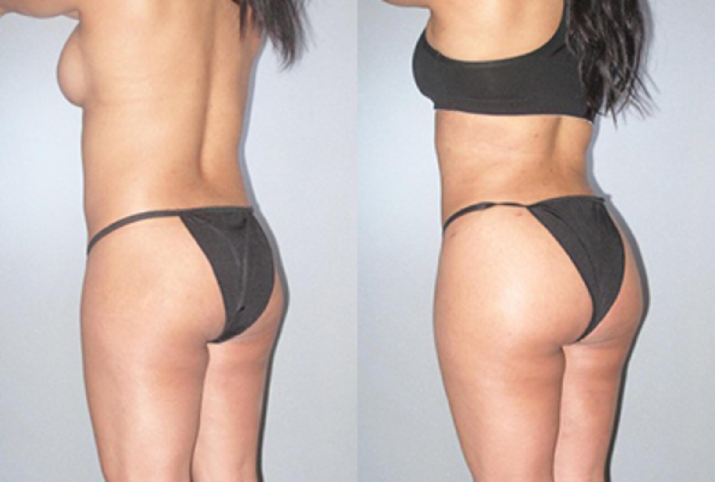 Before & After Brazilian Butt Lift Case 9235 View 2 View in Houston, TX