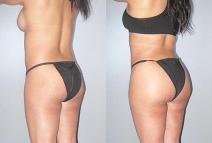 Before & After Brazilian Butt Lift Case 9235 View 2 View in Houston, TX