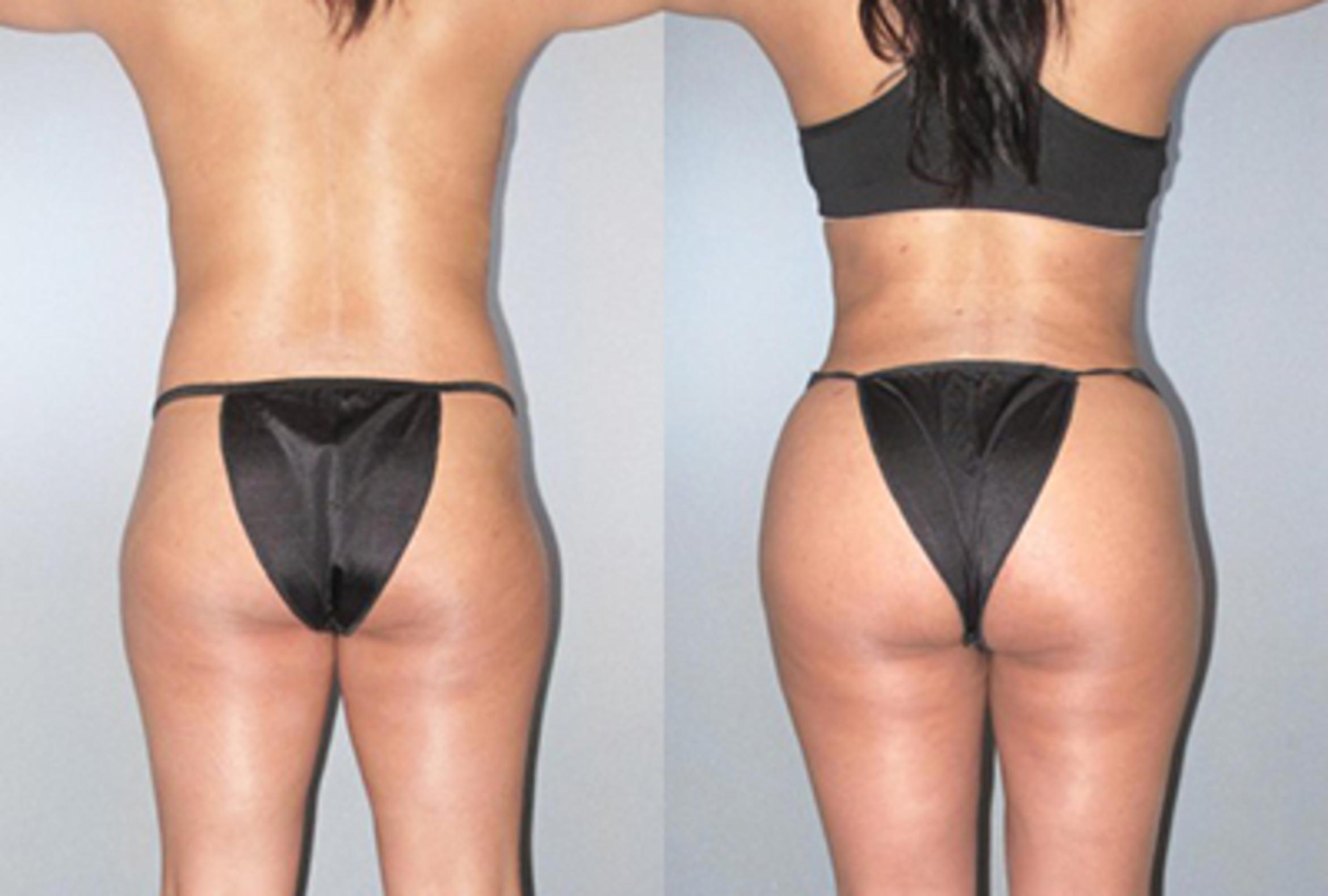 Before & After Brazilian Butt Lift Case 9235 View 3 View in Houston, TX