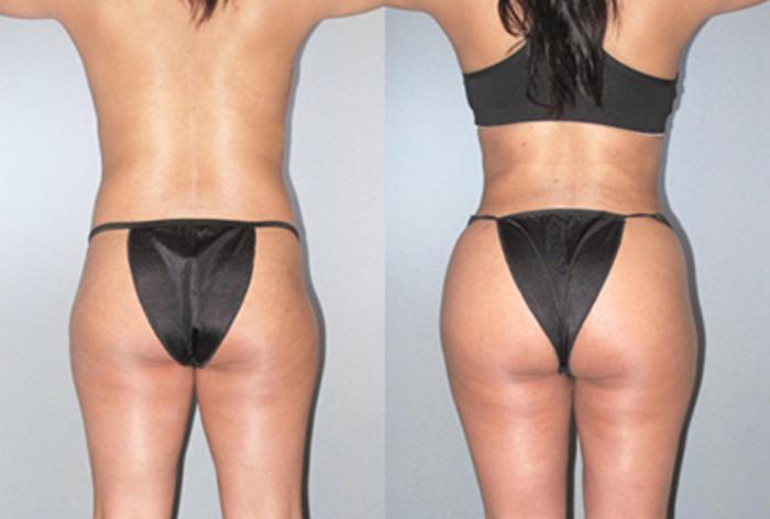 Before & After Brazilian Butt Lift Case 9235 View 3 View in Houston, TX