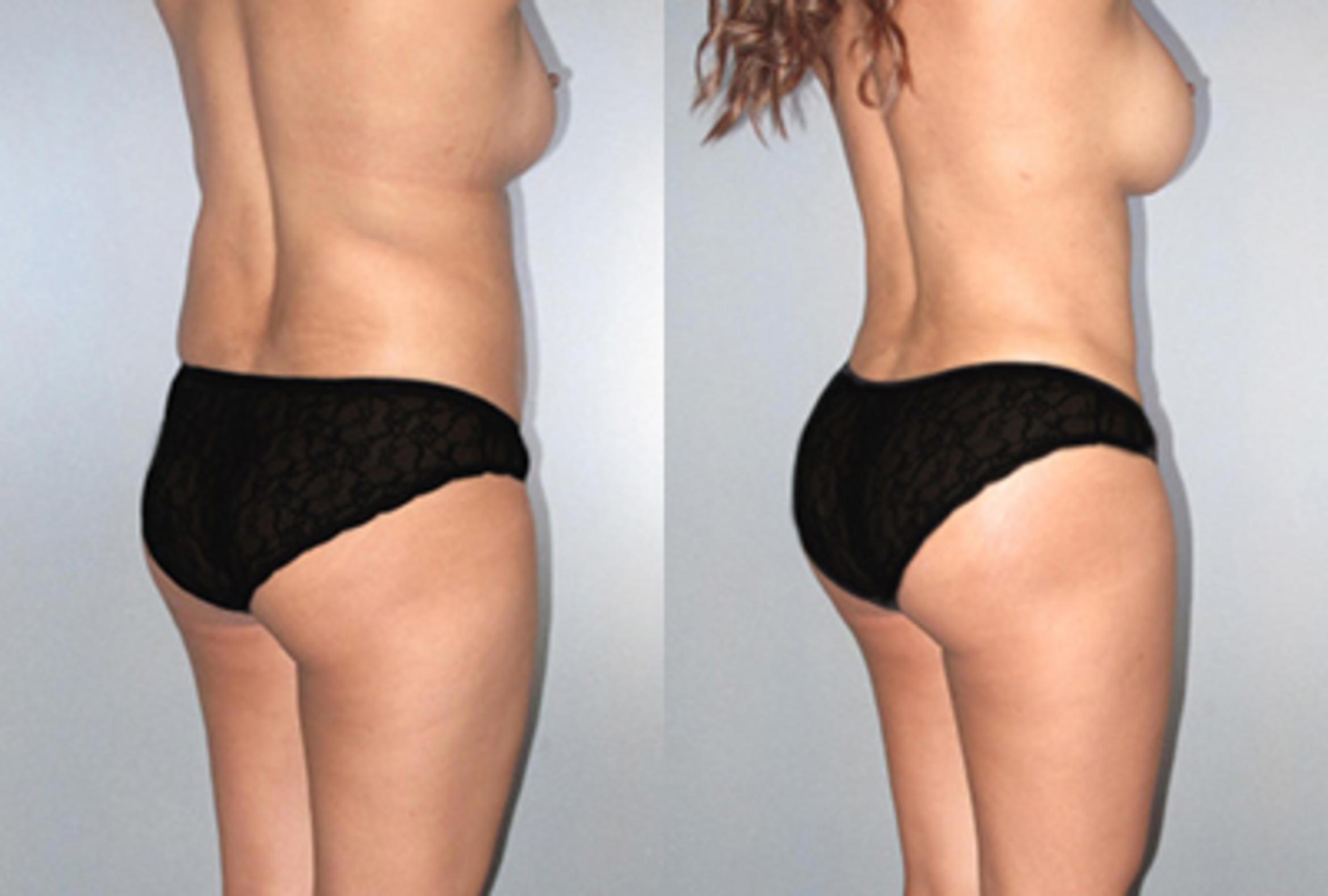 Before & After Brazilian Butt Lift Case 9361 View 1 View in Houston, TX