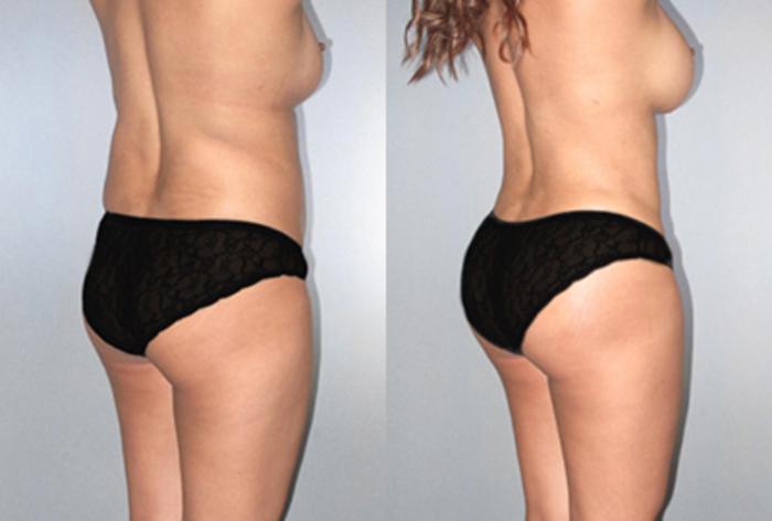 Before & After Brazilian Butt Lift Case 9361 View 1 View in Houston, TX