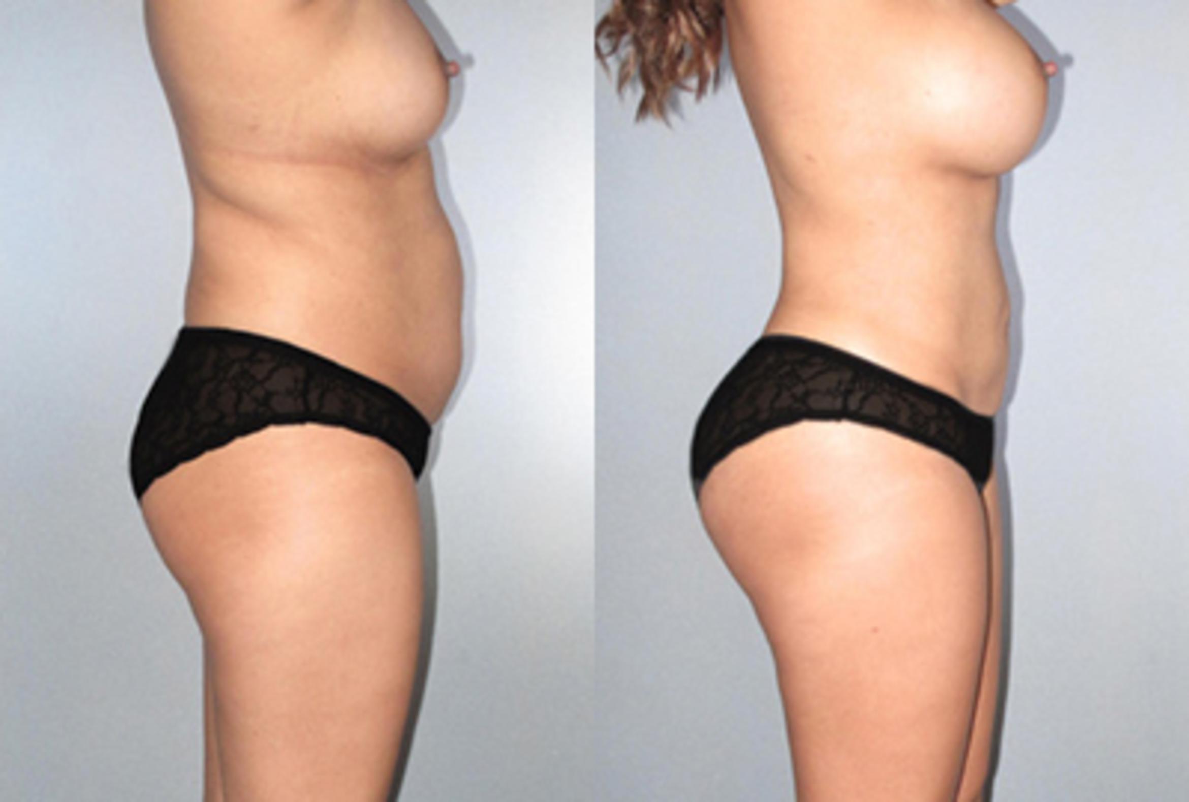 Before & After Brazilian Butt Lift Case 9361 View 2 View in Houston, TX