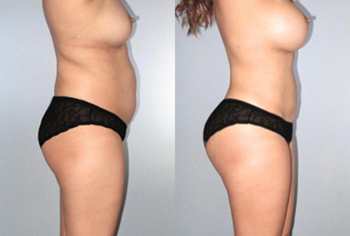 Before & After Brazilian Butt Lift Case 9361 View 2 View in Houston, TX