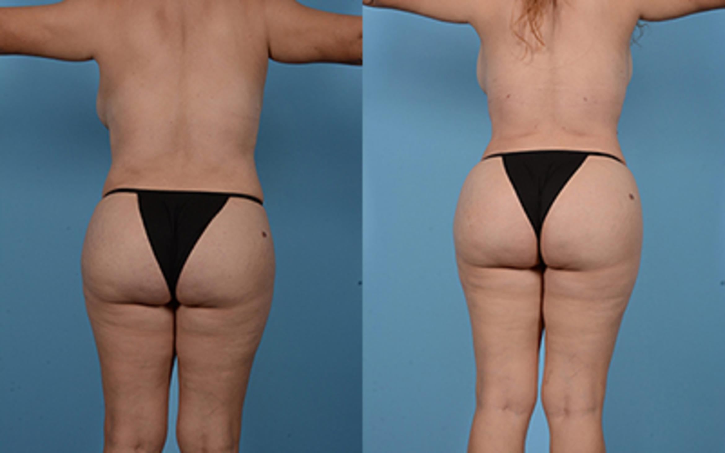 Before & After Brazilian Butt Lift Case 949079999 View 1 View in Houston, TX