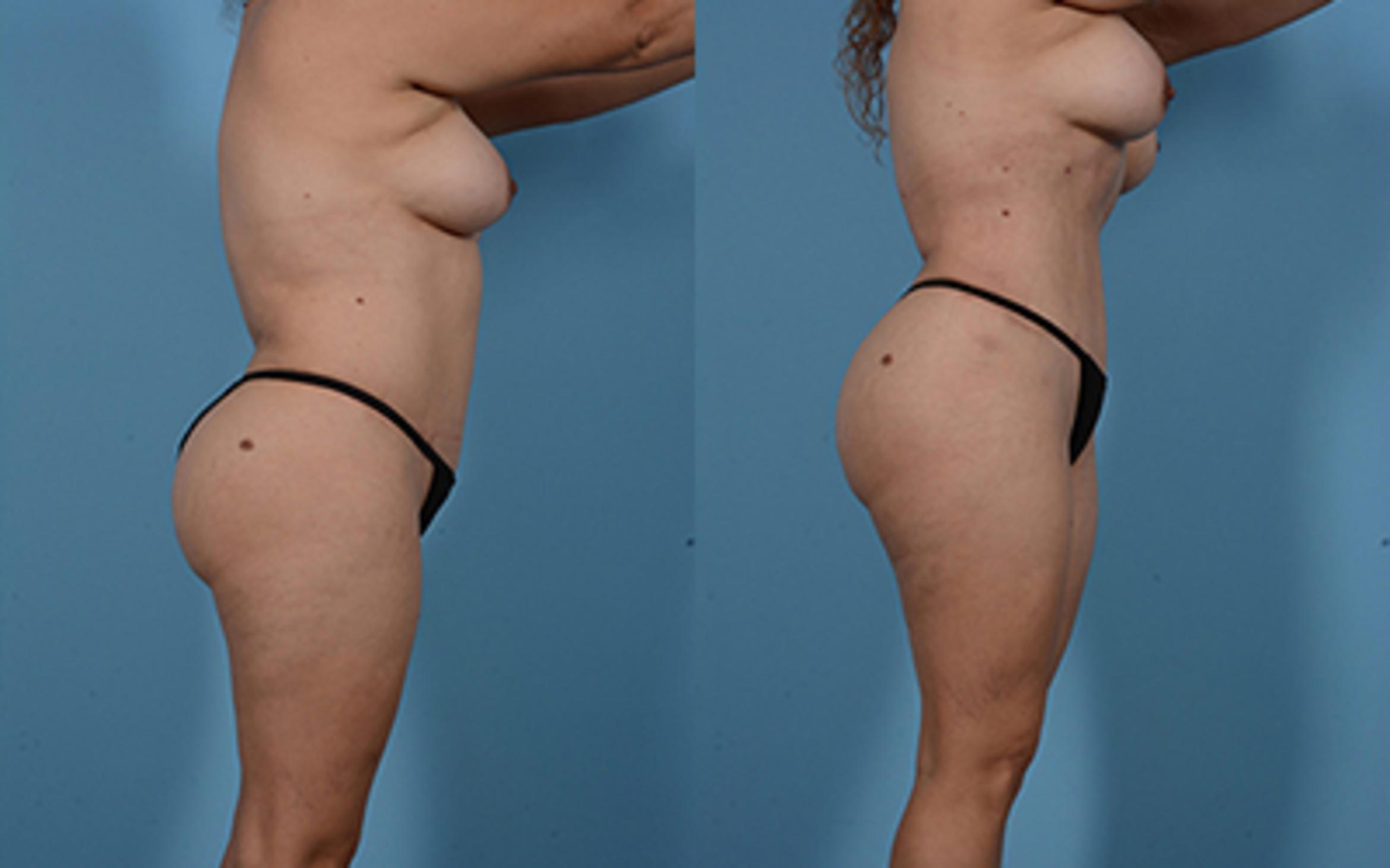 Before & After Brazilian Butt Lift Case 949079999 View 2 View in Houston, TX