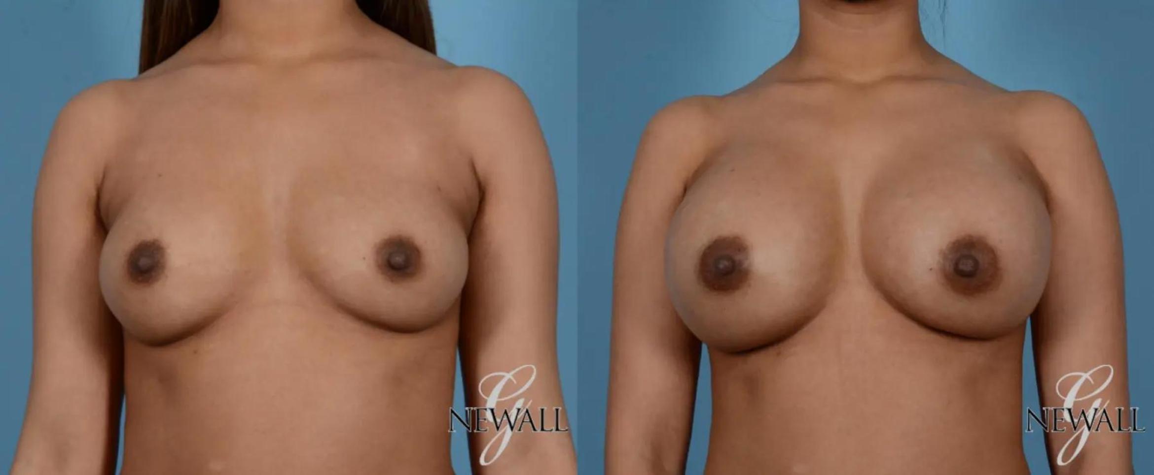 Before & After Breast Augmentation Case 16974 View 1 View in Houston, TX