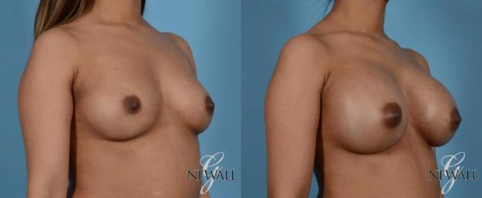 Before & After Breast Augmentation Case 16974 View 2 View in Houston, TX