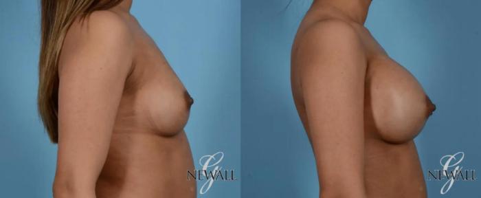 Before & After Breast Augmentation Case 16974 View 3 View in Houston, TX
