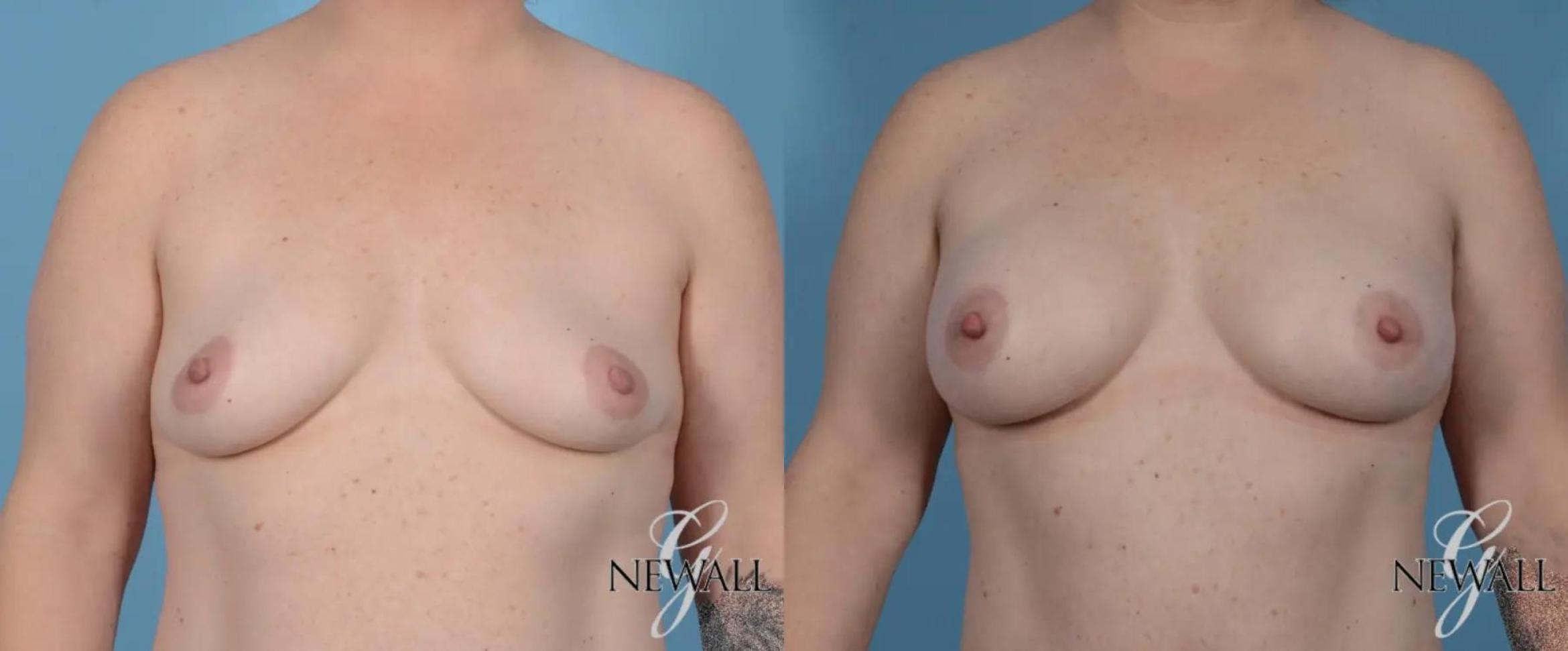 Before & After Breast Augmentation Case 16986 View 1 View in Houston, TX