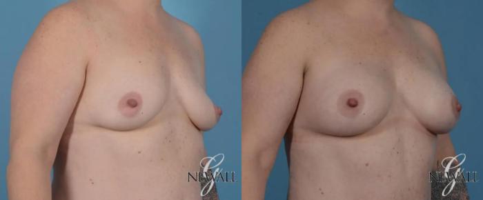 Before & After Breast Augmentation Case 16986 View 2 View in Houston, TX