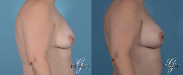 Before & After Breast Augmentation Case 16986 View 3 View in Houston, TX