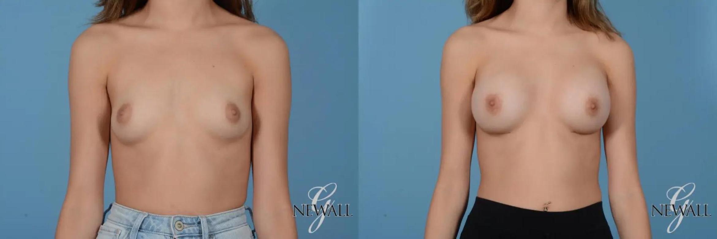 Before & After Breast Augmentation Case 16995 View 1 View in Houston, TX