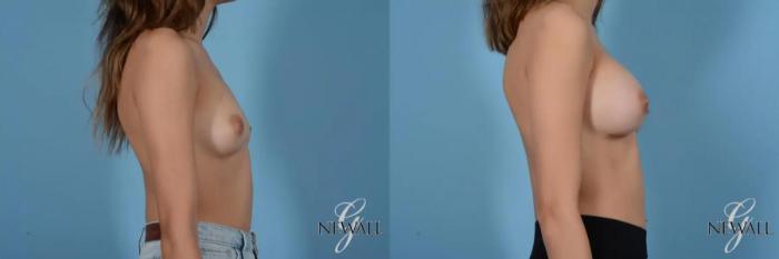 Before & After Breast Augmentation Case 16995 View 3 View in Houston, TX