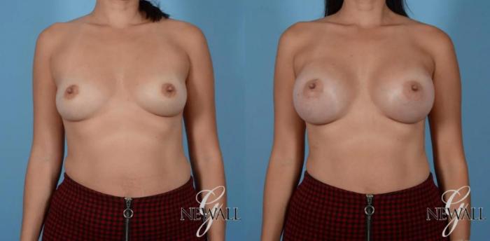 Before & After Breast Augmentation Case 16996 View 1 View in Houston, TX