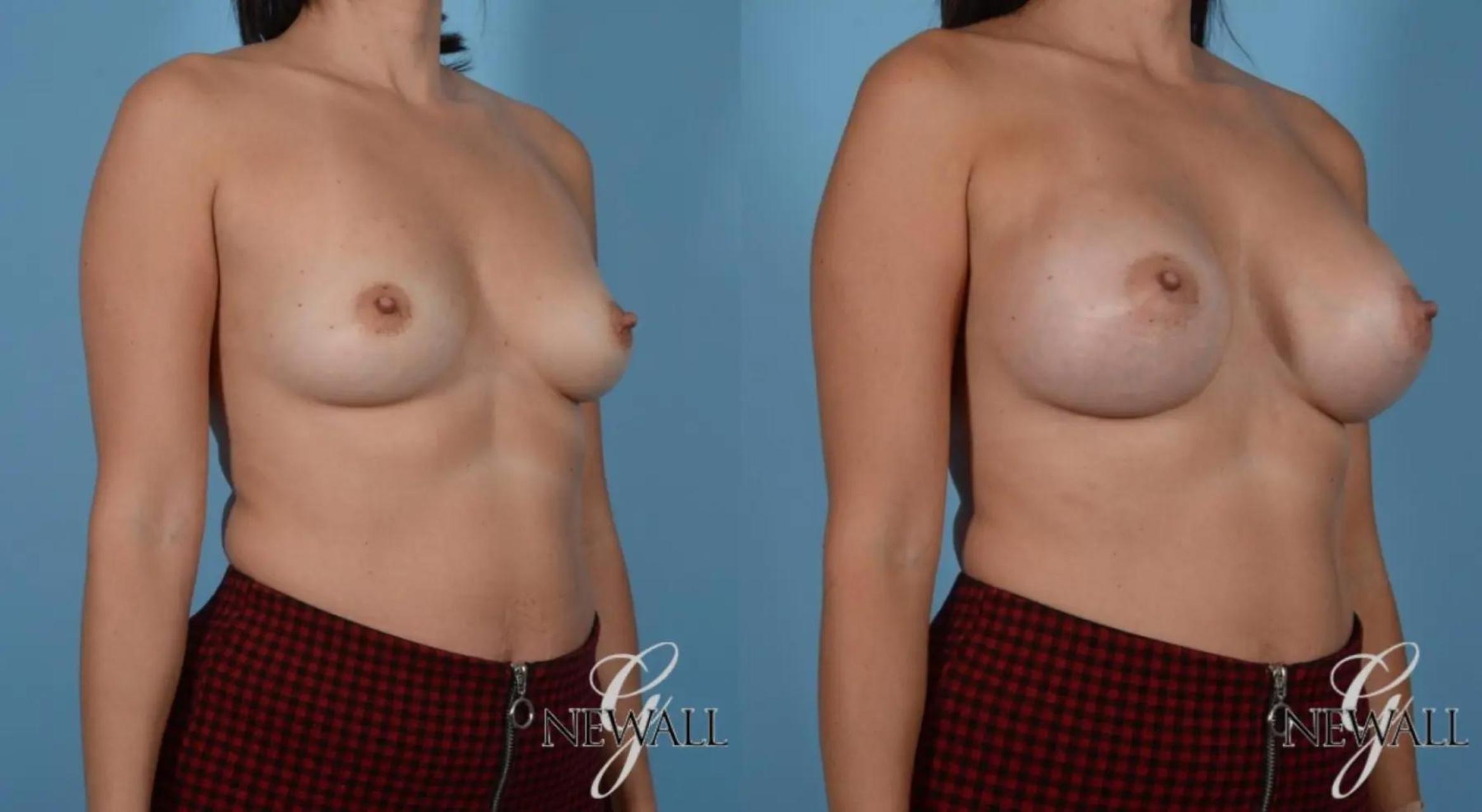 Before & After Breast Augmentation Case 16996 View 2 View in Houston, TX