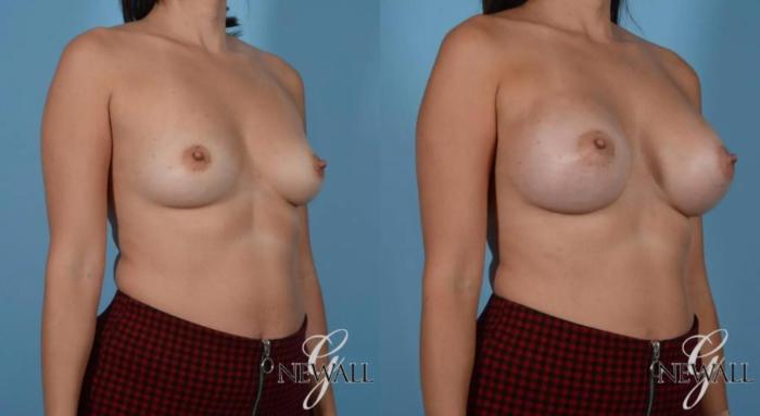Before & After Breast Augmentation Case 16996 View 2 View in Houston, TX
