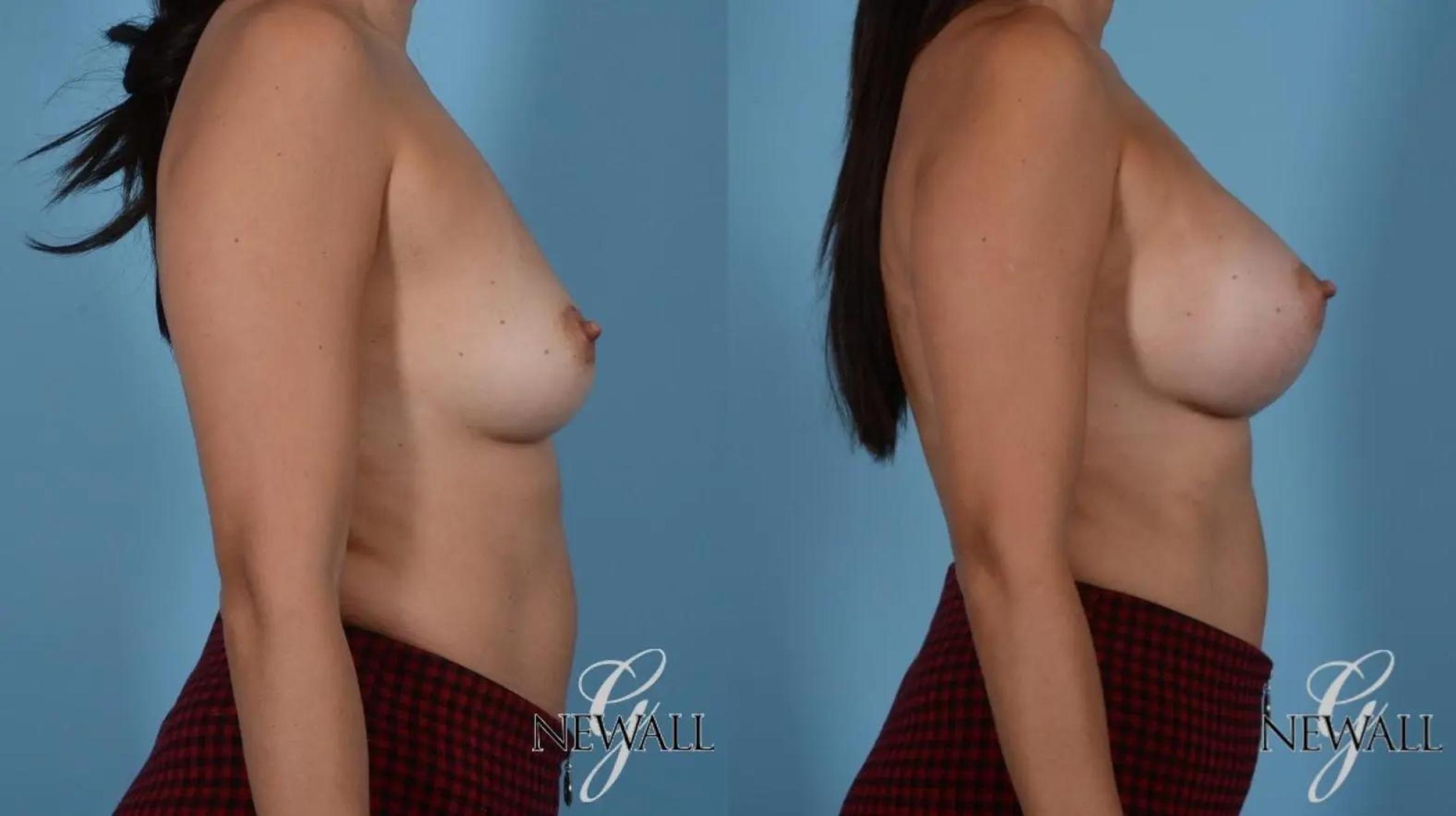 Before & After Breast Augmentation Case 16996 View 3 View in Houston, TX