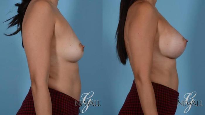 Before & After Breast Augmentation Case 16996 View 3 View in Houston, TX