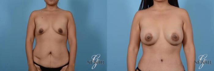 Before & After Breast Augmentation Case 17007 View 1 View in Houston, TX