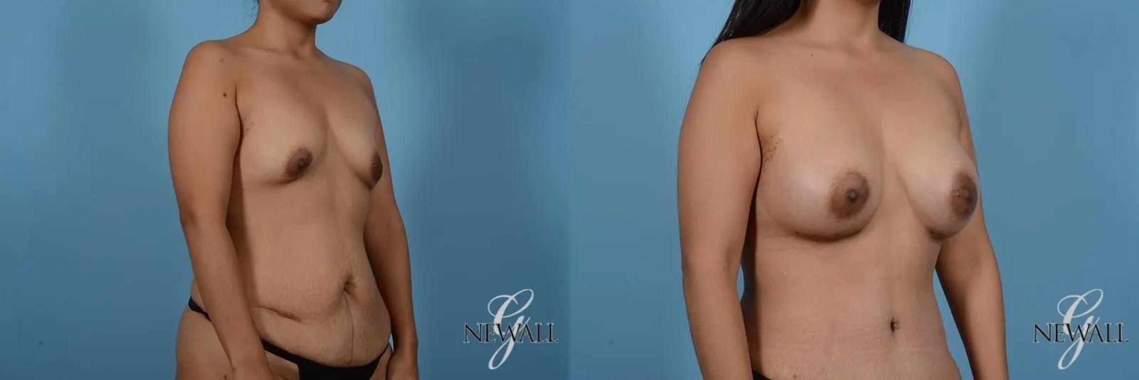 Before & After Breast Augmentation Case 17007 View 2 View in Houston, TX