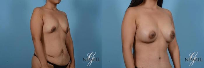 Before & After Breast Augmentation Case 17007 View 2 View in Houston, TX