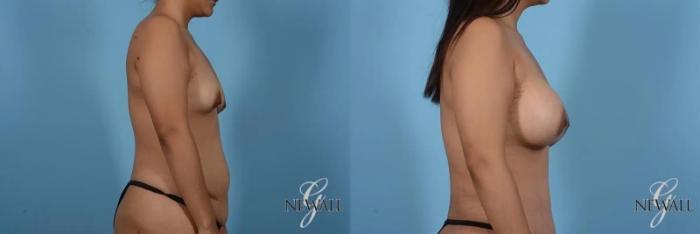 Before & After Breast Augmentation Case 17007 View 3 View in Houston, TX
