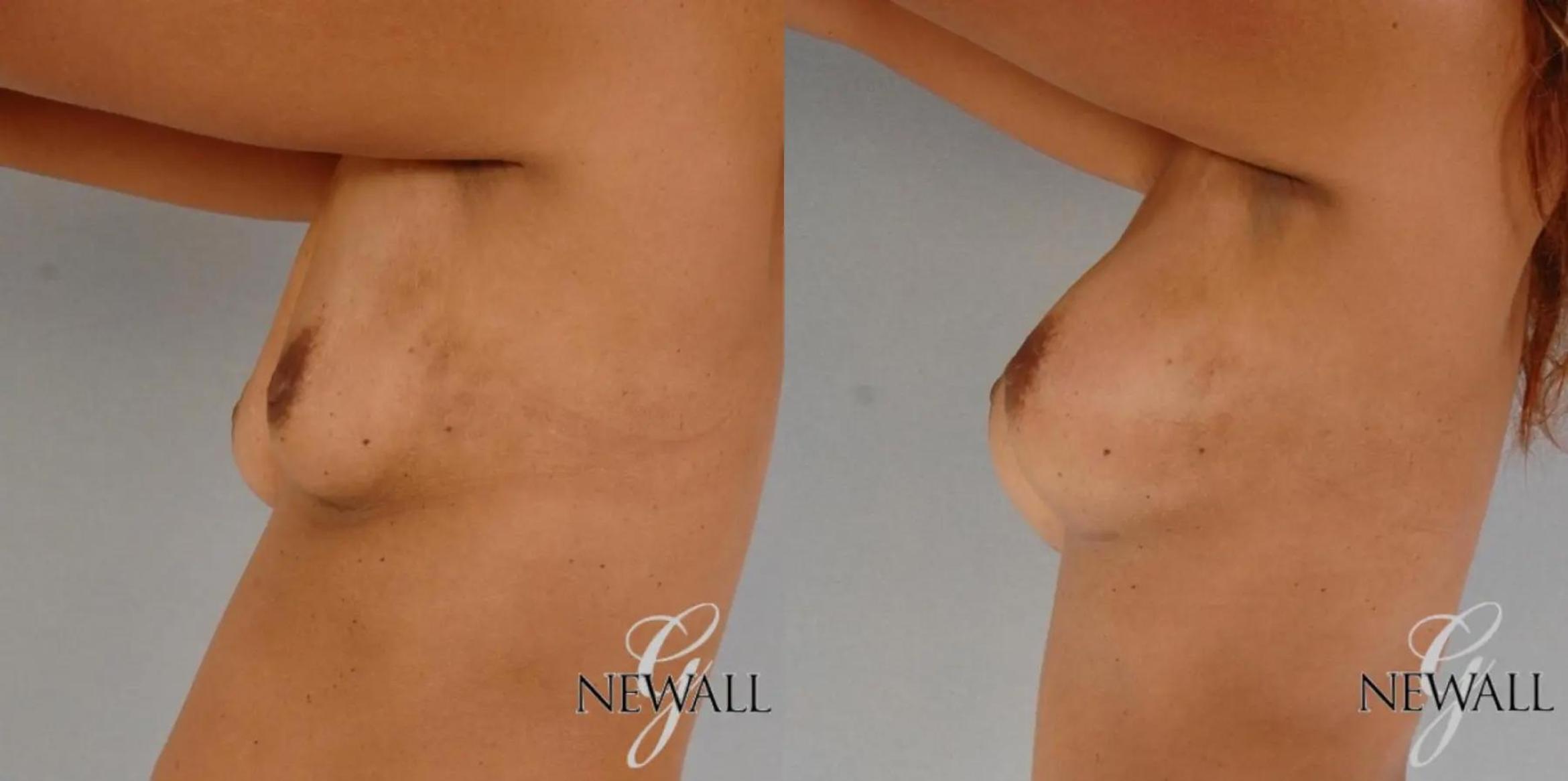 Before & After Breast Augmentation Case 17764 View 2 View in Houston, TX