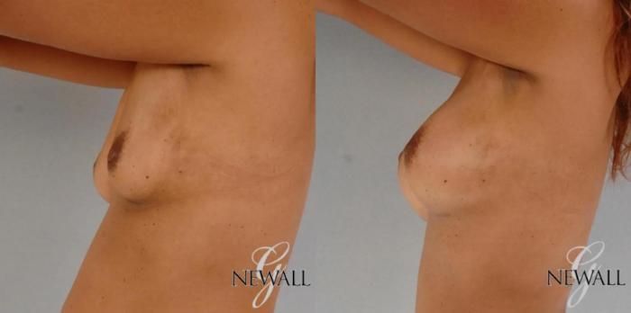 Before & After Breast Augmentation Case 17764 View 2 View in Houston, TX