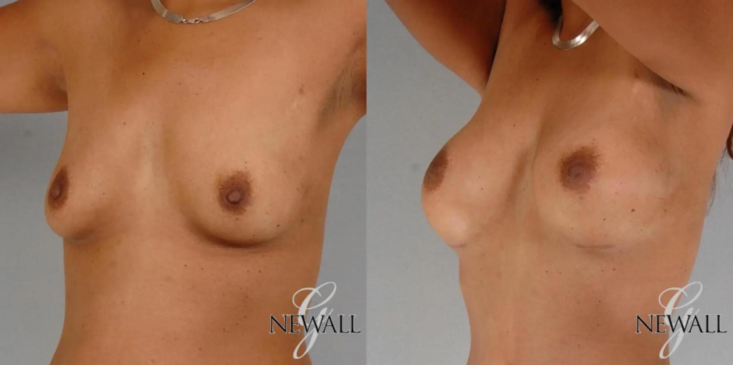 Before & After Breast Augmentation Case 17764 View 3 View in Houston, TX