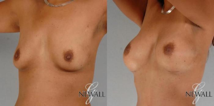 Before & After Breast Augmentation Case 17764 View 3 View in Houston, TX