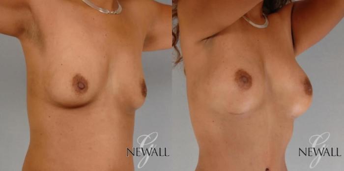 Before & After Breast Augmentation Case 17764 View 4 View in Houston, TX