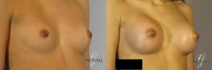 Before & After Breast Augmentation Case 17824 View 2 View in Houston, TX