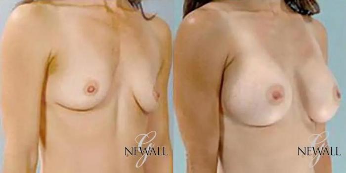 Before & After Breast Augmentation Case 18124 View 2 View in Houston, TX