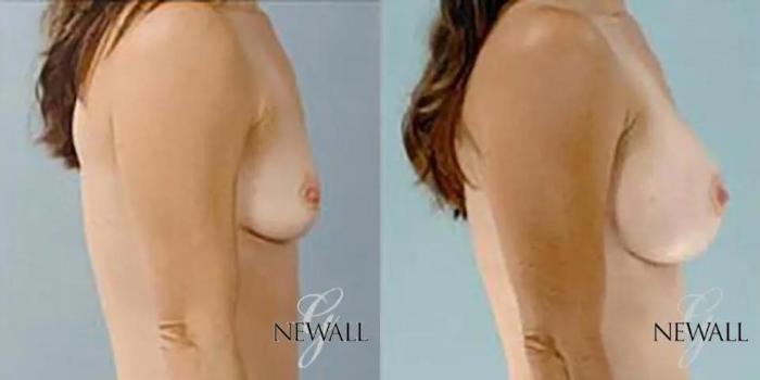 Before & After Breast Augmentation Case 18124 View 3 View in Houston, TX