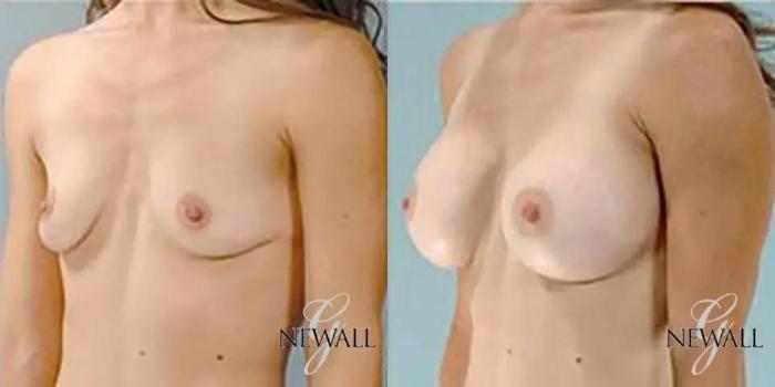 Before & After Breast Augmentation Case 18124 View 4 View in Houston, TX