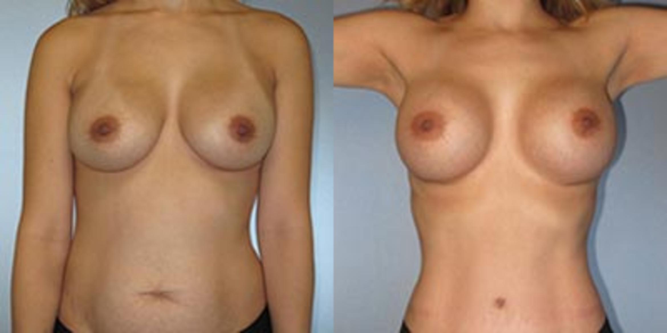 Before & After Breast Augmentation Case 365 View 1 View in Houston, TX