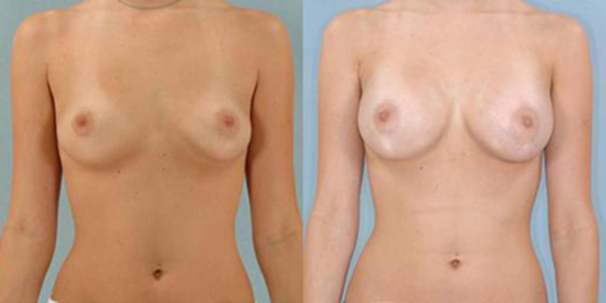 Before & After Breast Augmentation Case 4626 View 1 View in Houston, TX