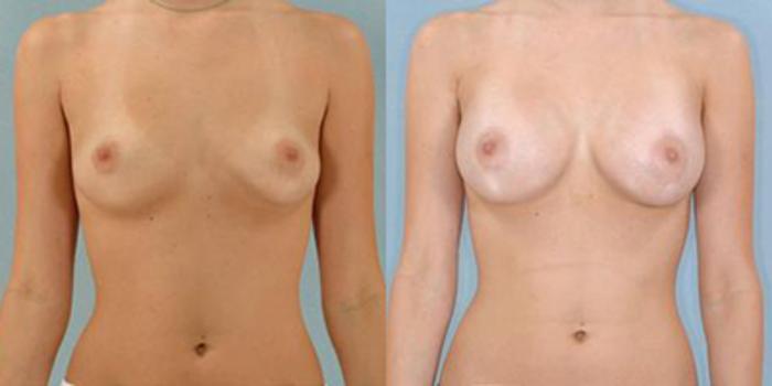 Before & After Breast Augmentation Case 4626 View 1 View in Houston, TX