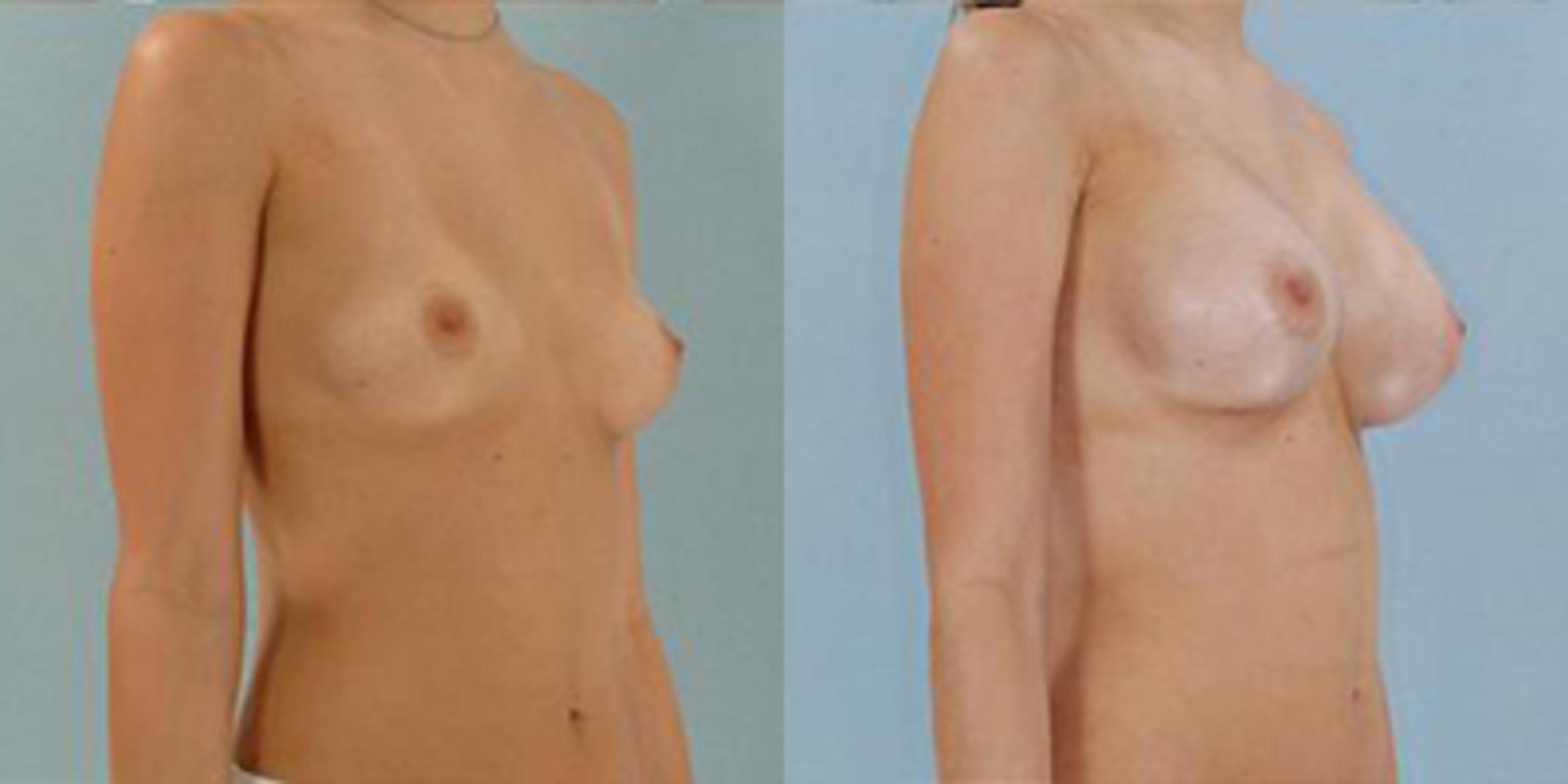Before & After Breast Augmentation Case 4626 View 2 View in Houston, TX