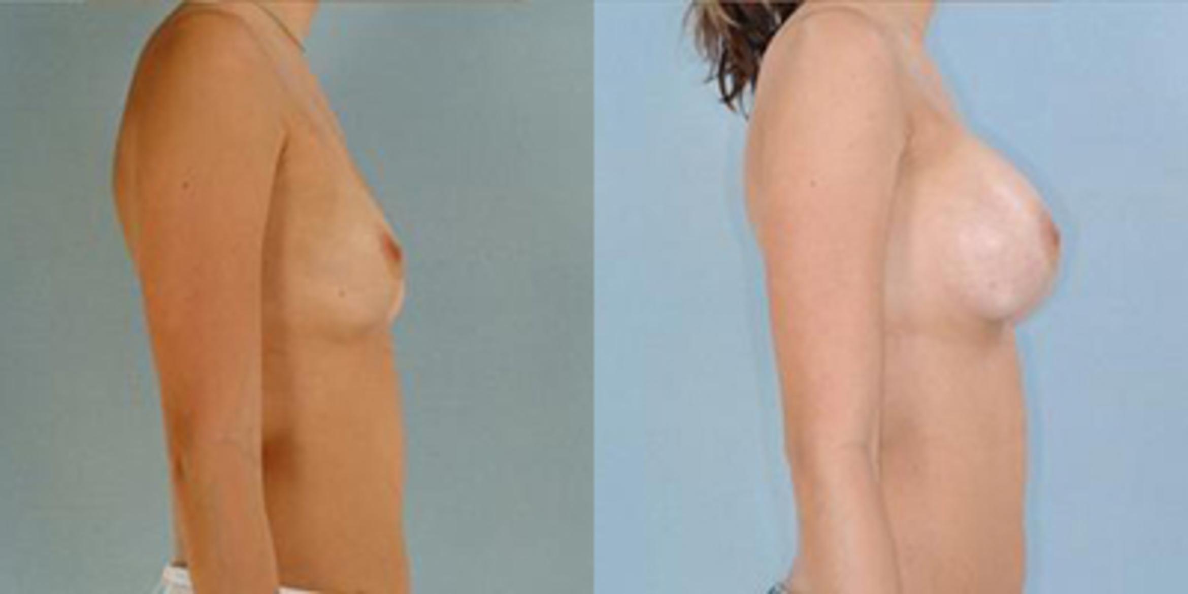 Before & After Breast Augmentation Case 4626 View 3 View in Houston, TX