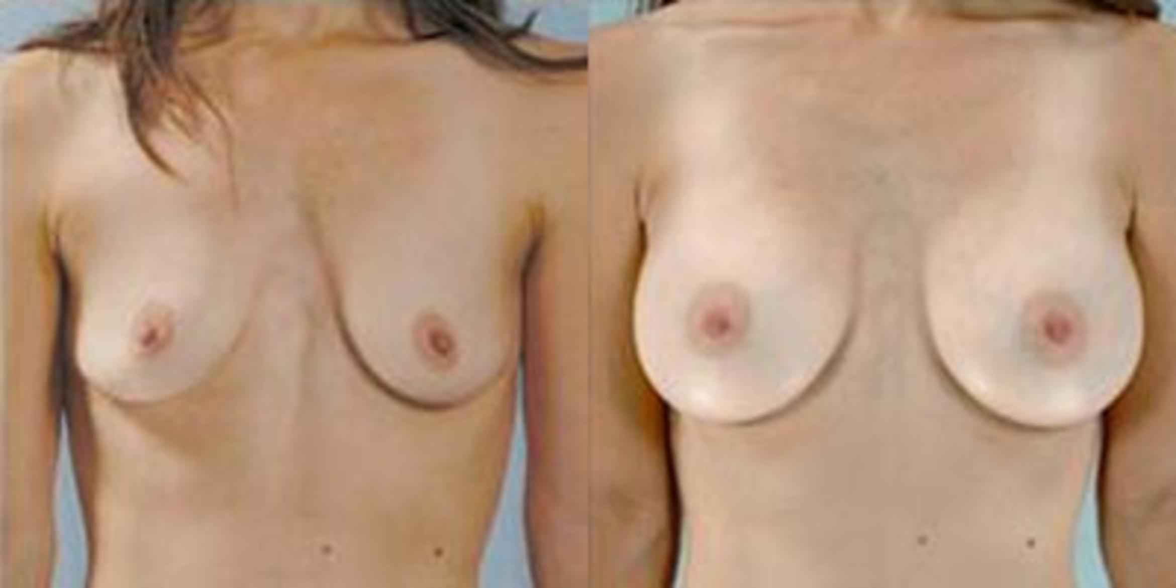 Before & After Breast Augmentation Case 4634 View 1 View in Houston, TX