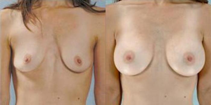Before & After Breast Augmentation Case 4634 View 1 View in Houston, TX
