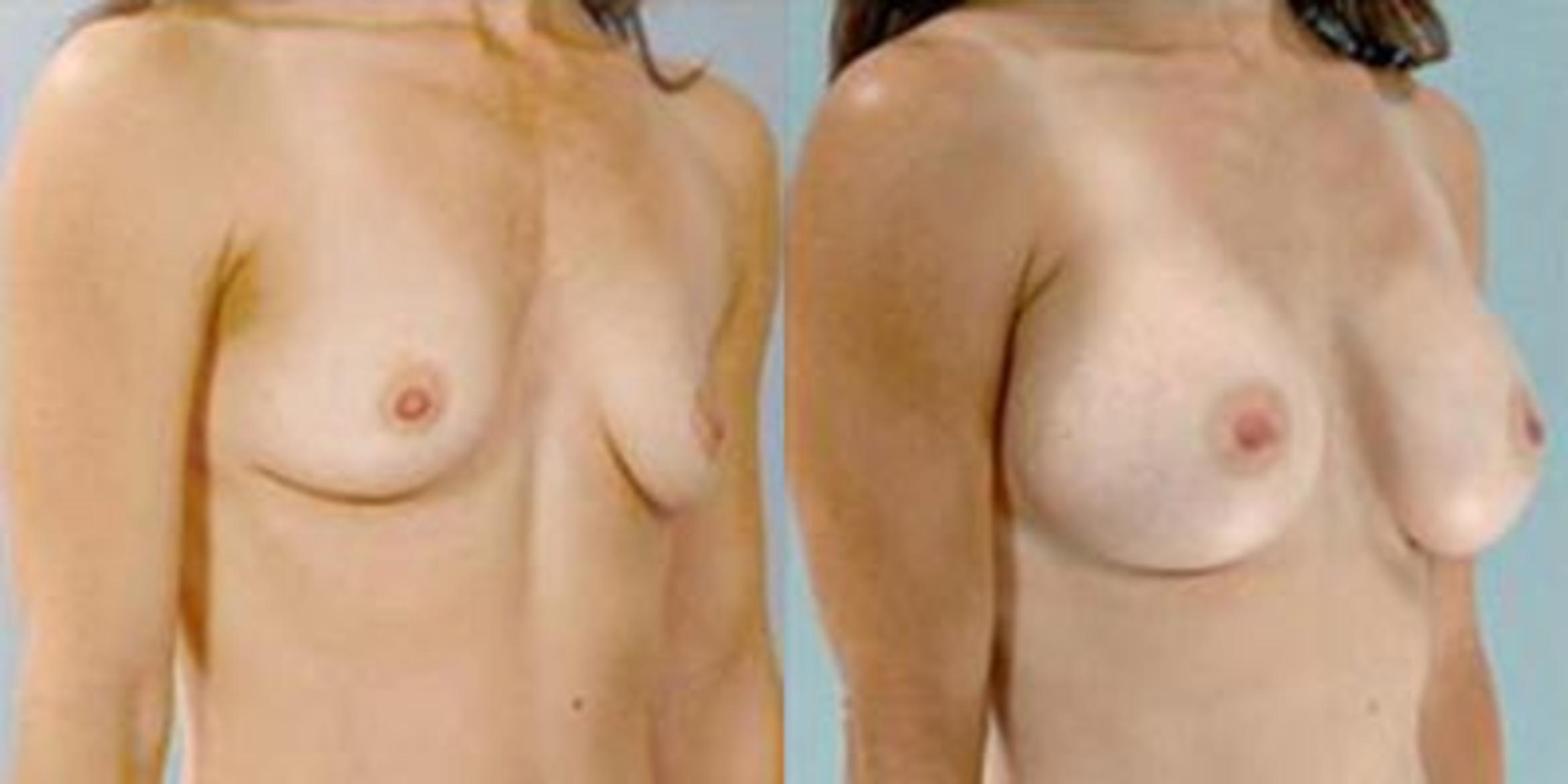Before & After Breast Augmentation Case 4634 View 2 View in Houston, TX