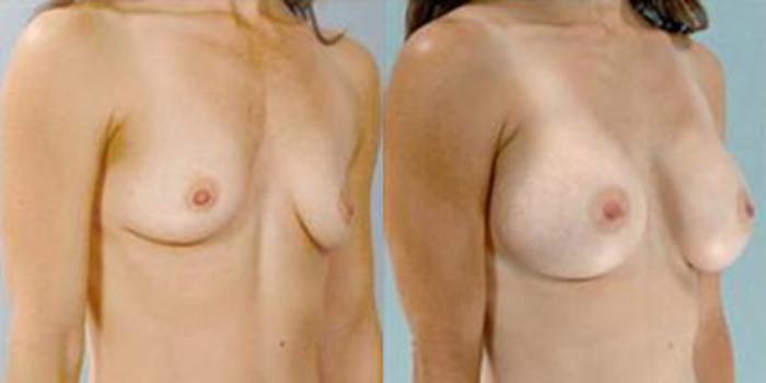 Before & After Breast Augmentation Case 4634 View 2 View in Houston, TX