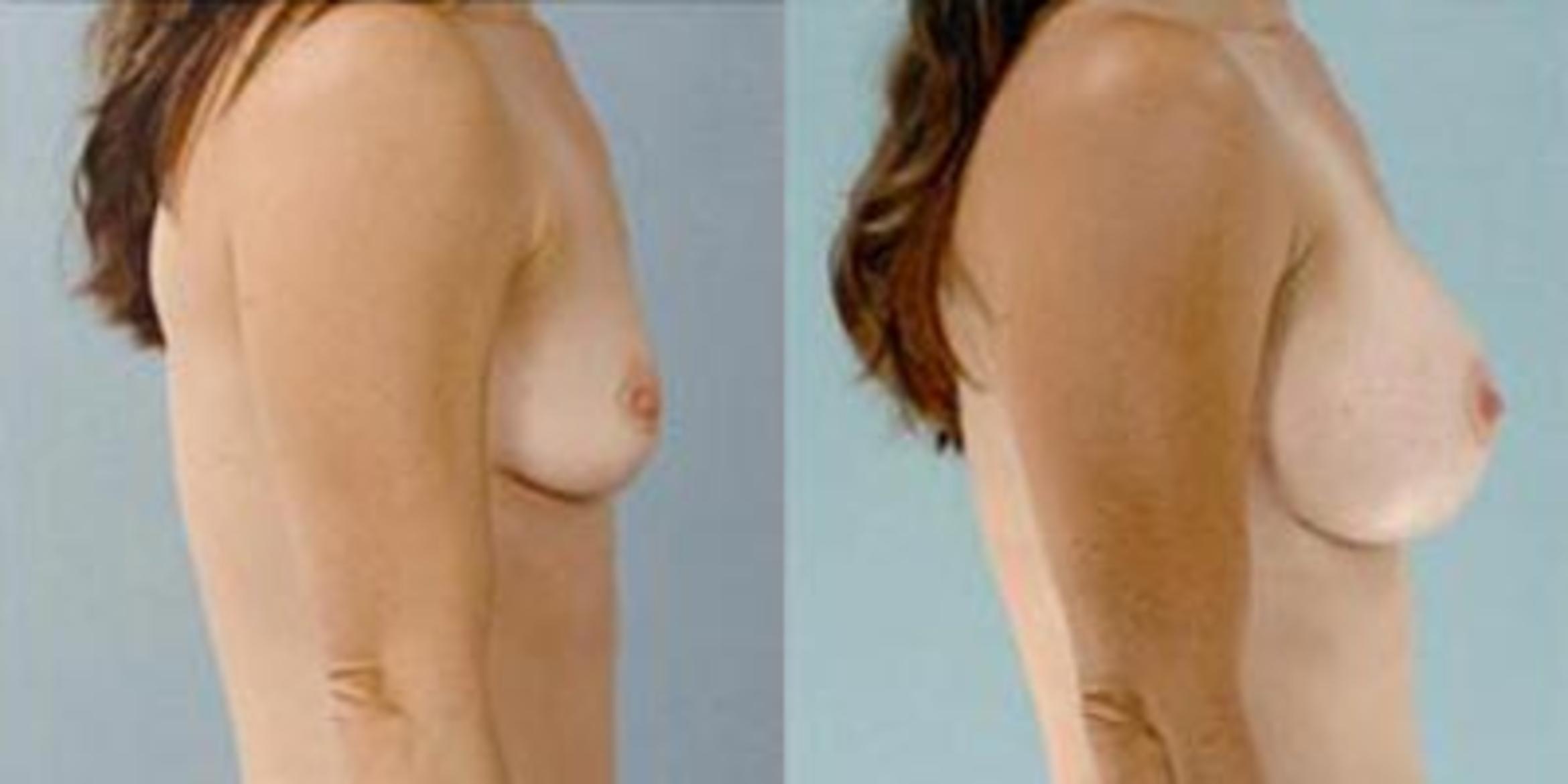Before & After Breast Augmentation Case 4634 View 3 View in Houston, TX
